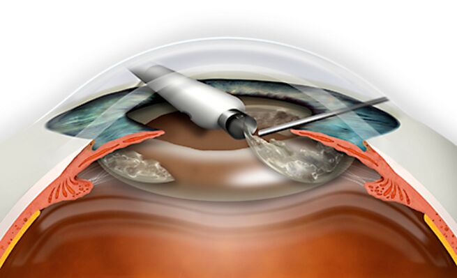 The lens is filled through the micronade that excludes blood loss
