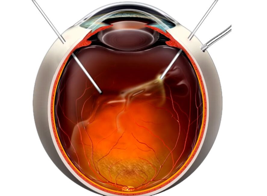 Vitrectomy - a procedure presented to people when peeling the retina